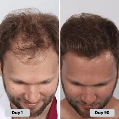 Gorro de terapia de luz roja para el tratamiento del crecimiento del cabello